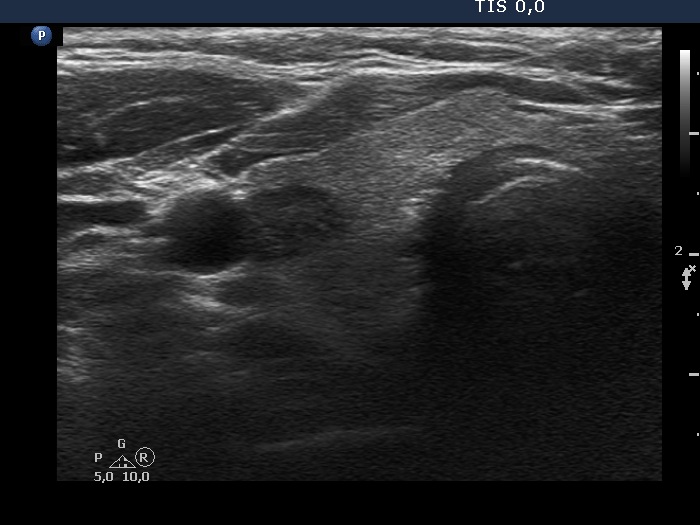 Right lobe, longitudinal scan