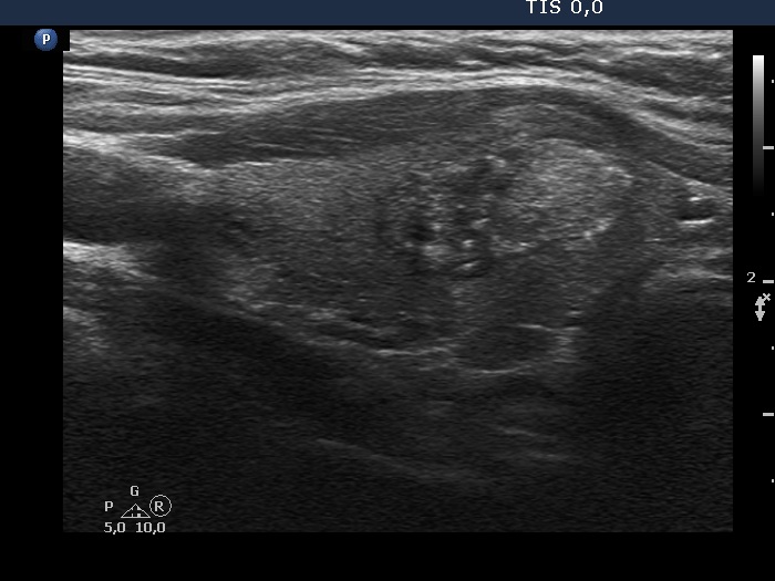 Right lobe, longitudinal scan