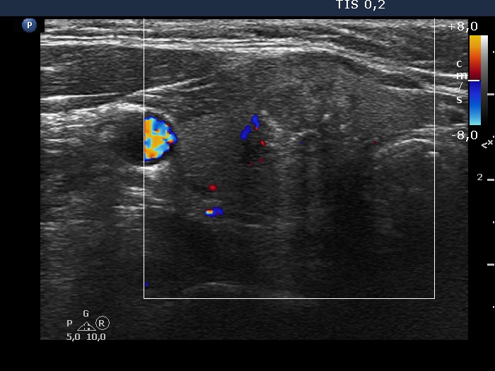 Right lobe, longitudinal scan