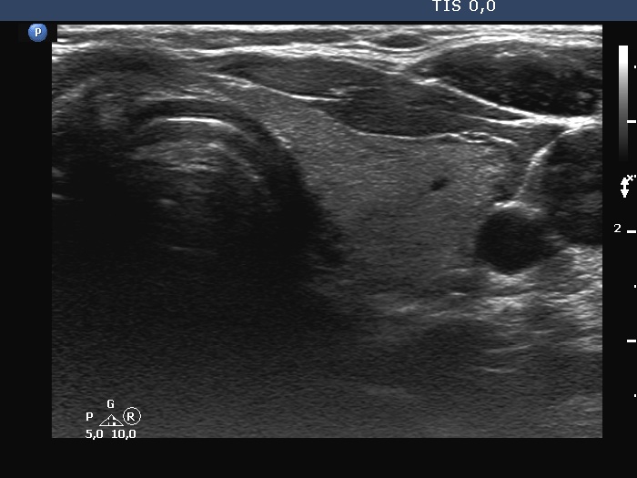 Right lobe, longitudinal scan