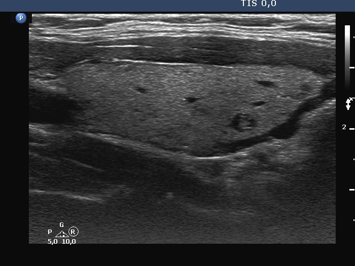 Right lobe, longitudinal scan
