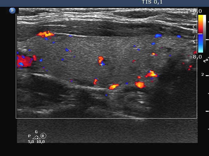 Right lobe, longitudinal scan