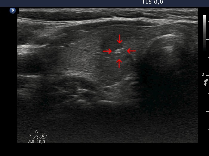 Right lobe, longitudinal scan