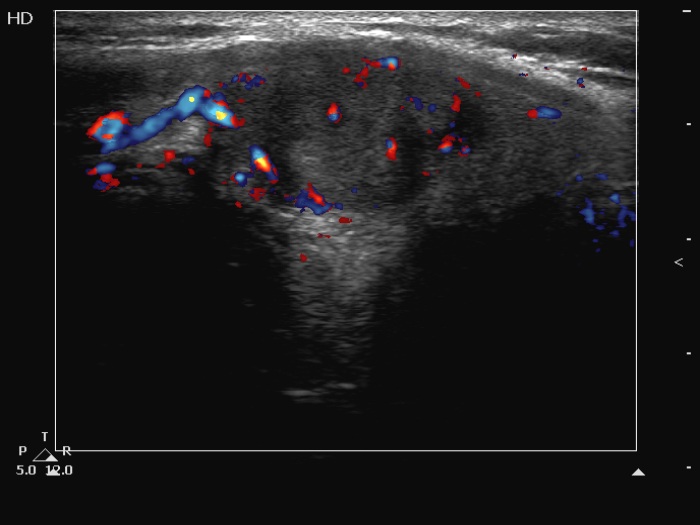 Right lobe, longitudinal scan
