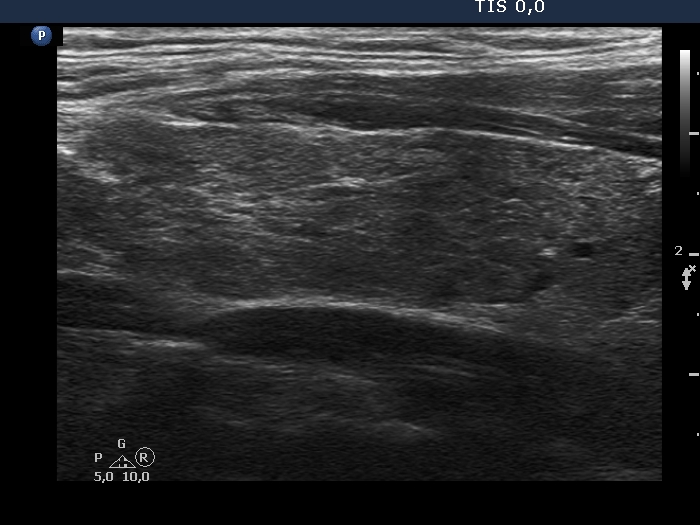 Right lobe, longitudinal scan