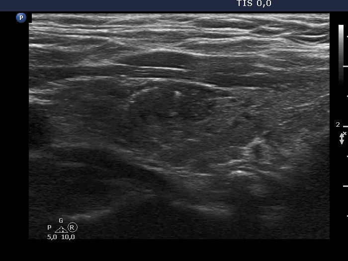 Right lobe, longitudinal scan