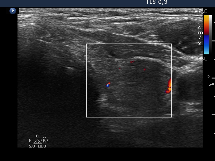 Right lobe, longitudinal scan