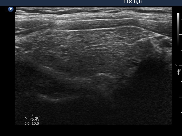 Right lobe, longitudinal scan