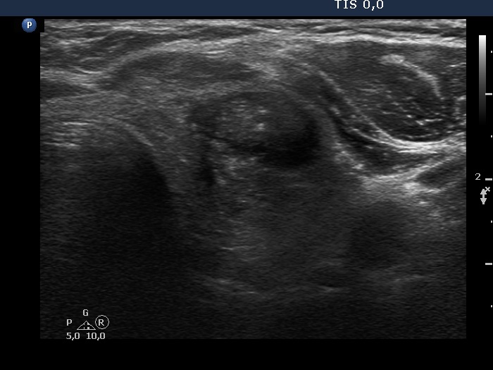 Right lobe, longitudinal scan