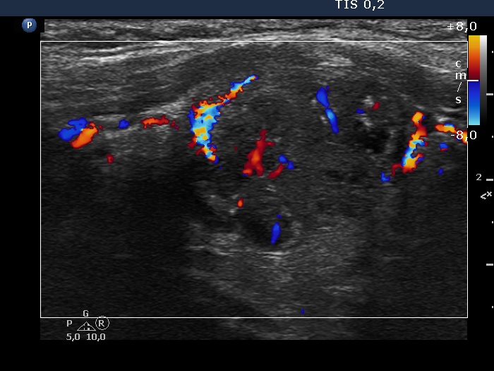 Right lobe, longitudinal scan