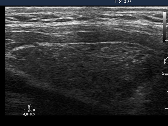 Right lobe, longitudinal scan