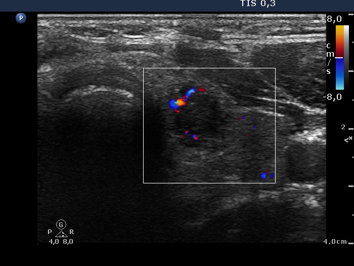 Right lobe, longitudinal scan