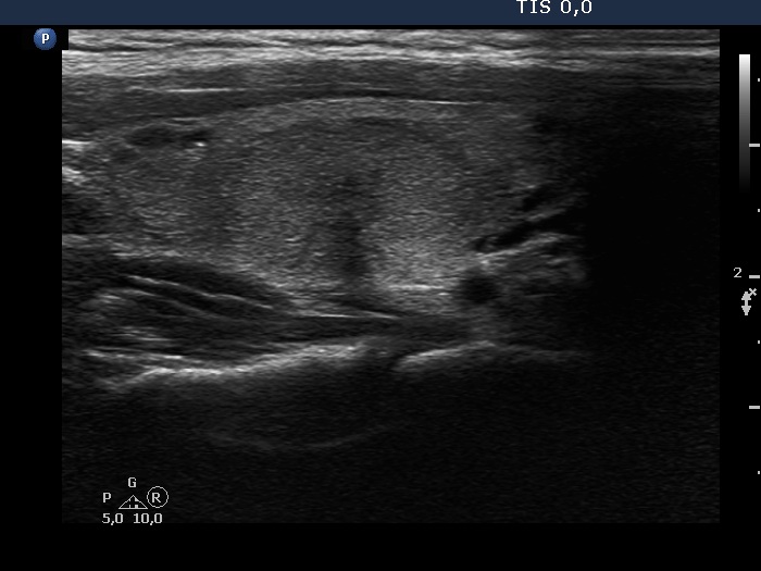 Right lobe, longitudinal scan