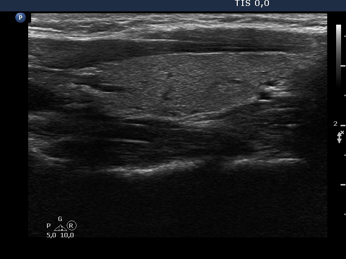 Right lobe, longitudinal scan