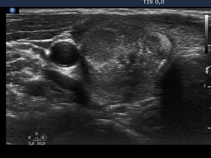Right lobe, longitudinal scan