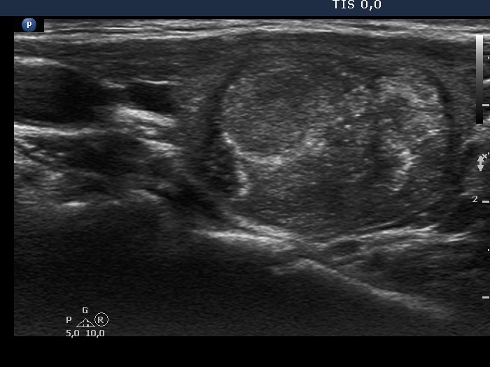 Right lobe, longitudinal scan