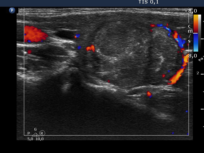 Right lobe, longitudinal scan