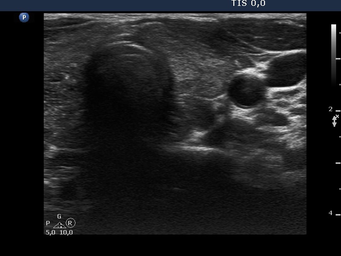Right lobe, longitudinal scan