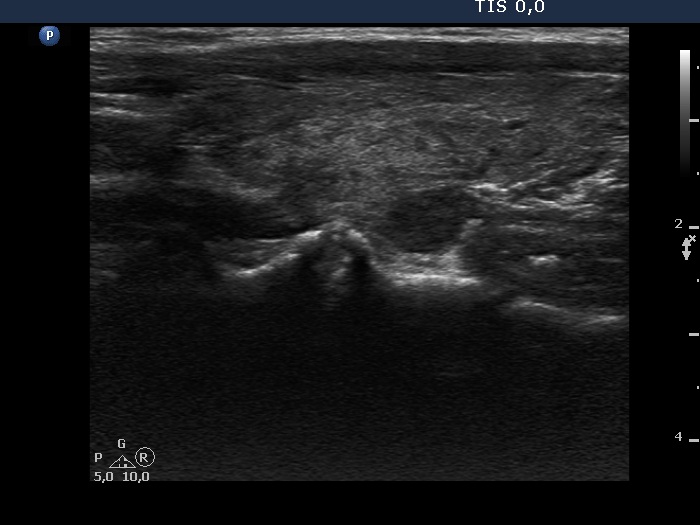 Right lobe, longitudinal scan