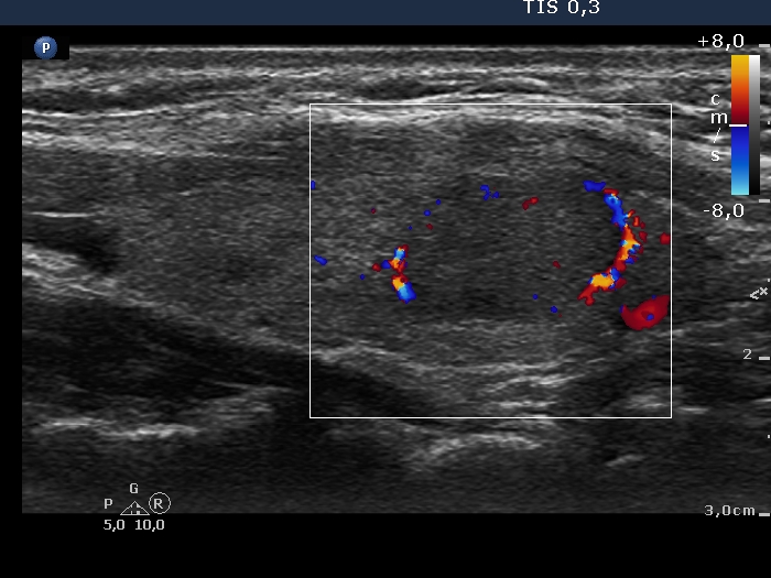 Right lobe, longitudinal scan