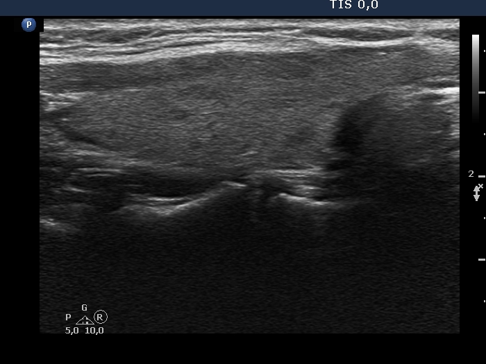 Right lobe, longitudinal scan