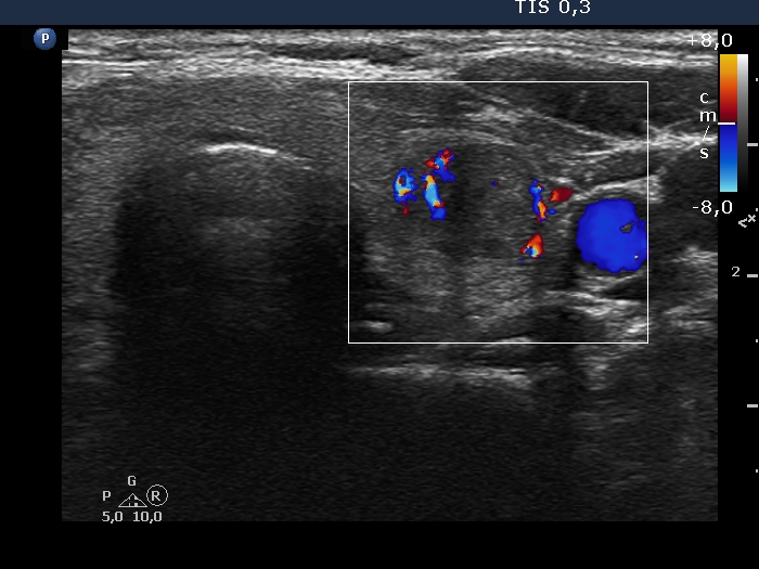 Right lobe, longitudinal scan