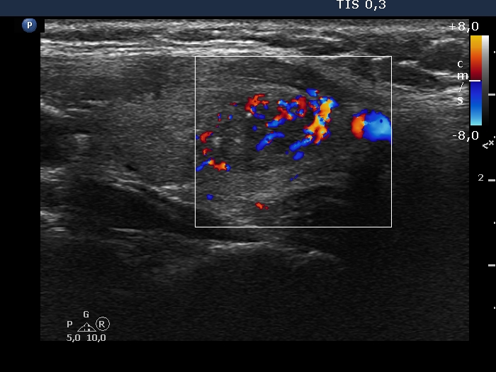 Right lobe, longitudinal scan