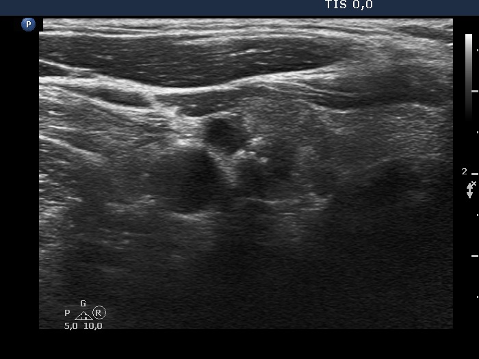 Right lobe, longitudinal scan