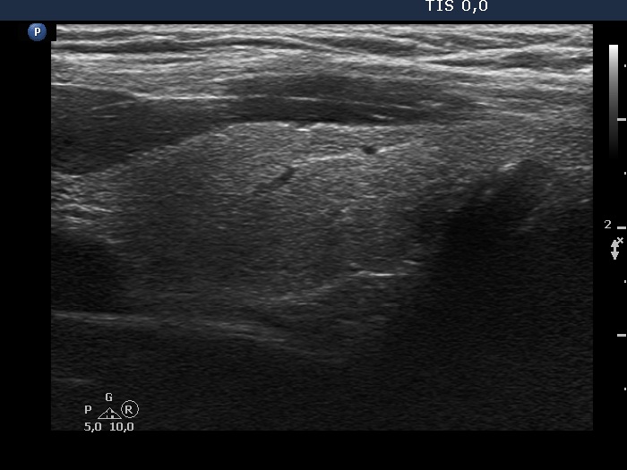 Right lobe, longitudinal scan