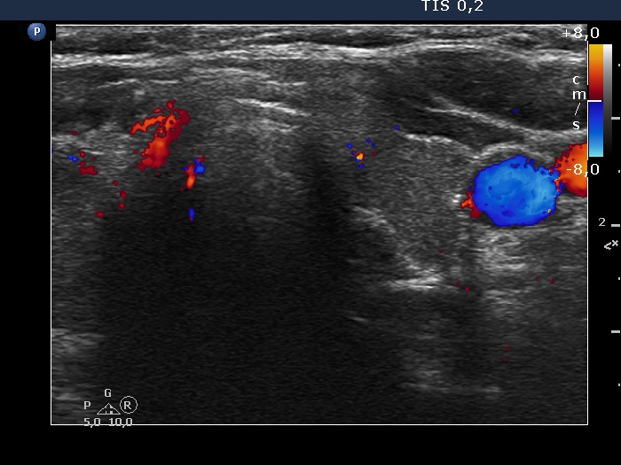 Right lobe, longitudinal scan