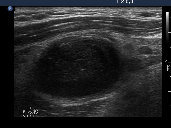 Right lobe, longitudinal scan
