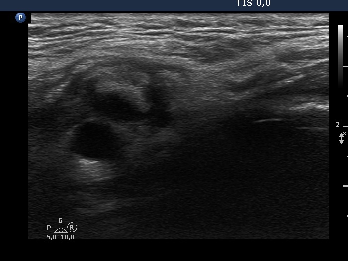 Right lobe, longitudinal scan