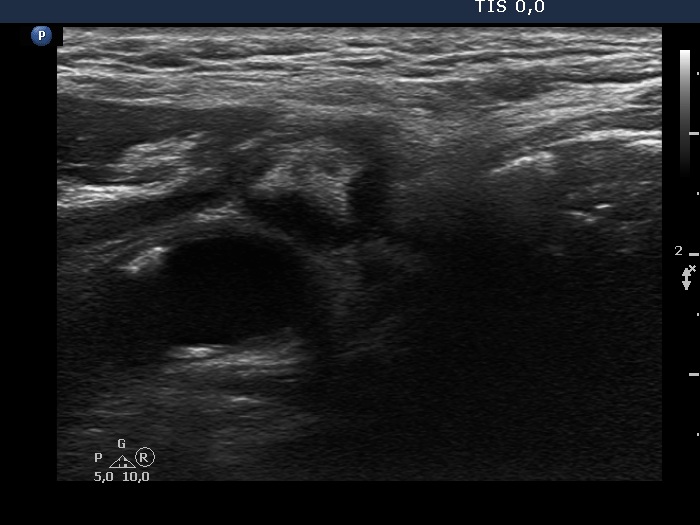 Right lobe, longitudinal scan