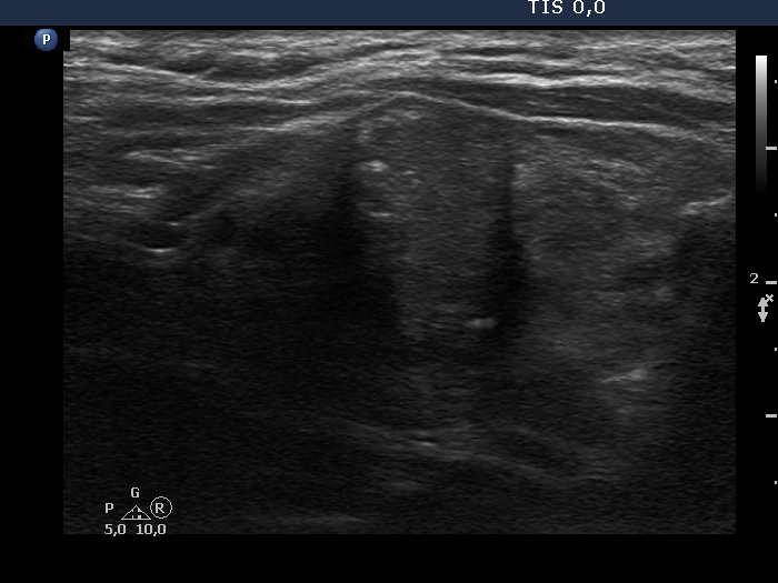 Right lobe, longitudinal scan