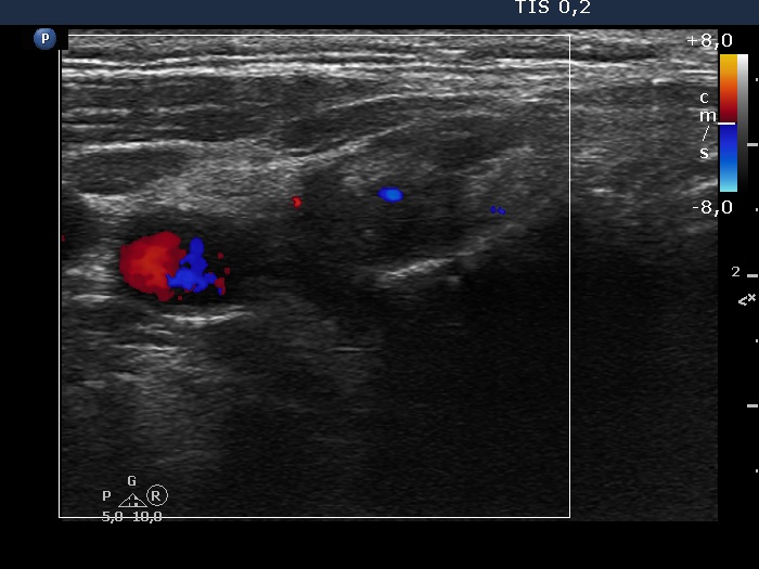 Right lobe, longitudinal scan