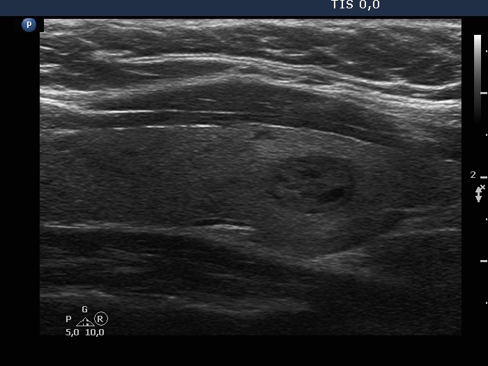 Right lobe, longitudinal scan