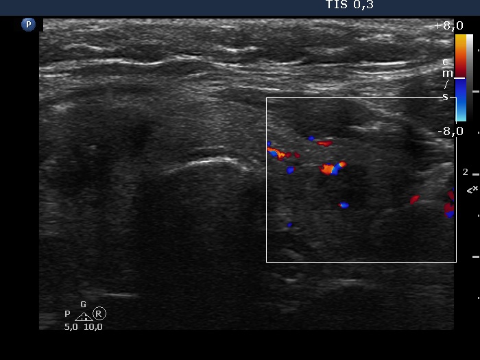 Right lobe, longitudinal scan