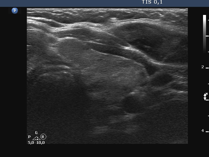 Right lobe, longitudinal scan
