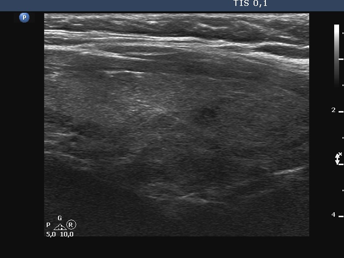 Right lobe, longitudinal scan