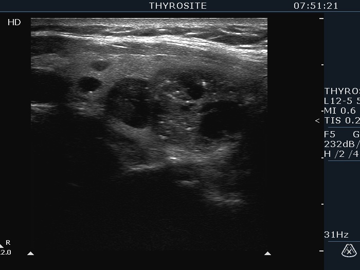 Right lobe, longitudinal scan