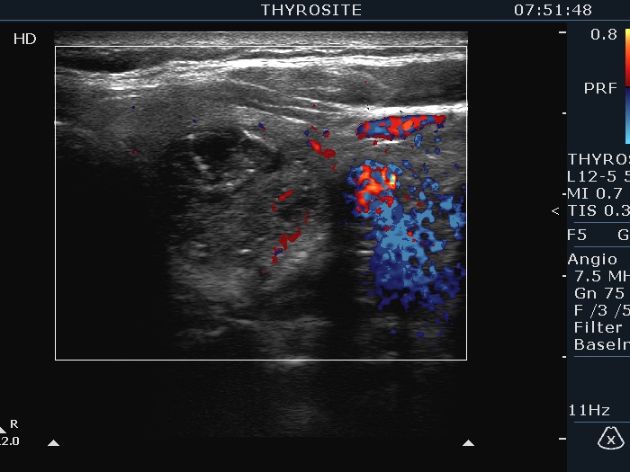 Right lobe, longitudinal scan