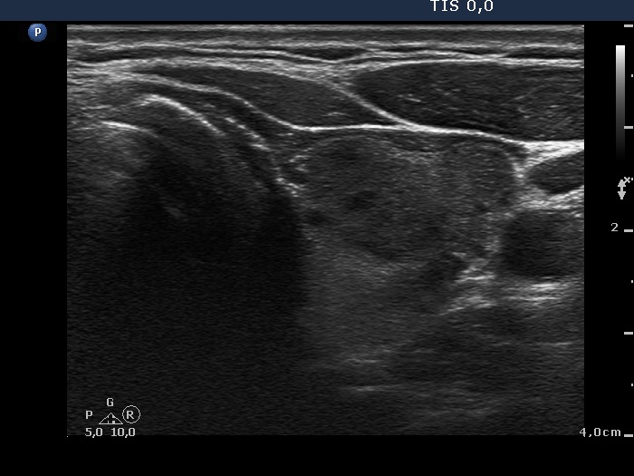 Right lobe, longitudinal scan