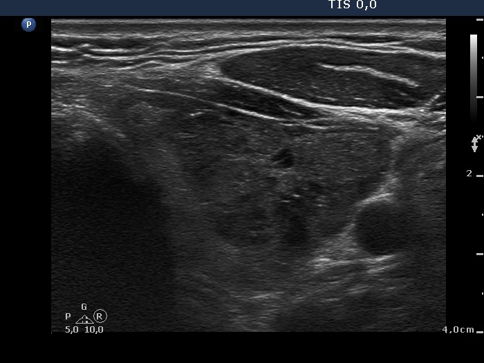 Right lobe, longitudinal scan
