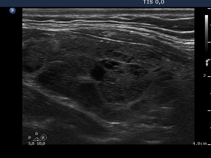 Right lobe, longitudinal scan