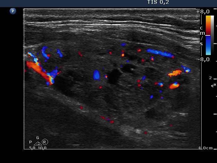 Right lobe, longitudinal scan