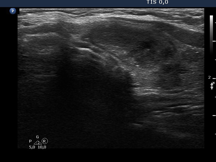 Right lobe, longitudinal scan