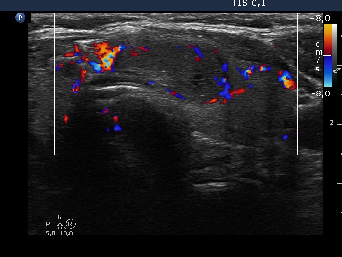 Right lobe, longitudinal scan