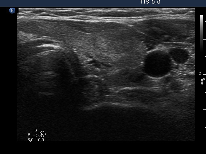 Right lobe, longitudinal scan