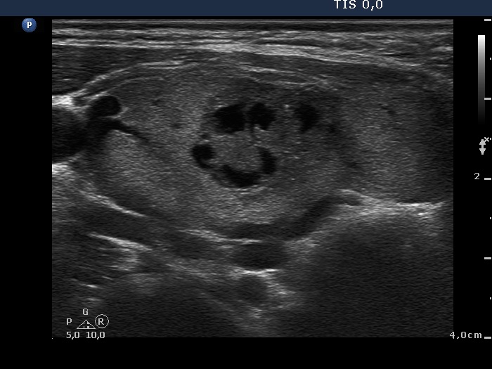 Right lobe, longitudinal scan