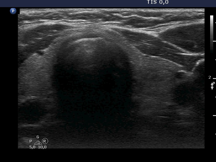Right lobe, longitudinal scan